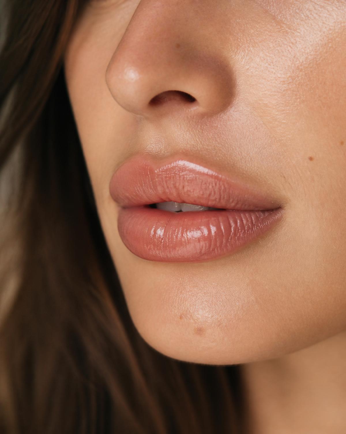 Lip Filler